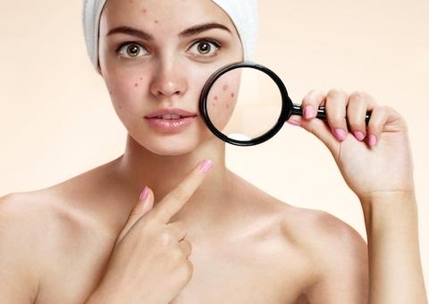 Espinhas no rosto podem ser confundidas com doença crônica ligada ao estresse