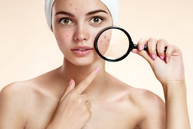 Espinhas no rosto podem ser confundidas com doença crônica ligada ao estresse