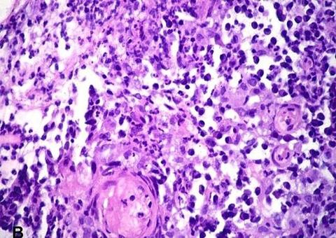 Mulher contrai doença rara que come a pele dos órgãos genitais