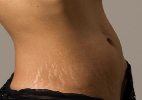 Quatro dicas para tratar e prevenir estrias