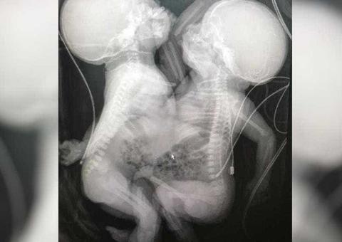 Recém-nascidas, siamesas separadas em Goiânia estão em estado gravíssimo