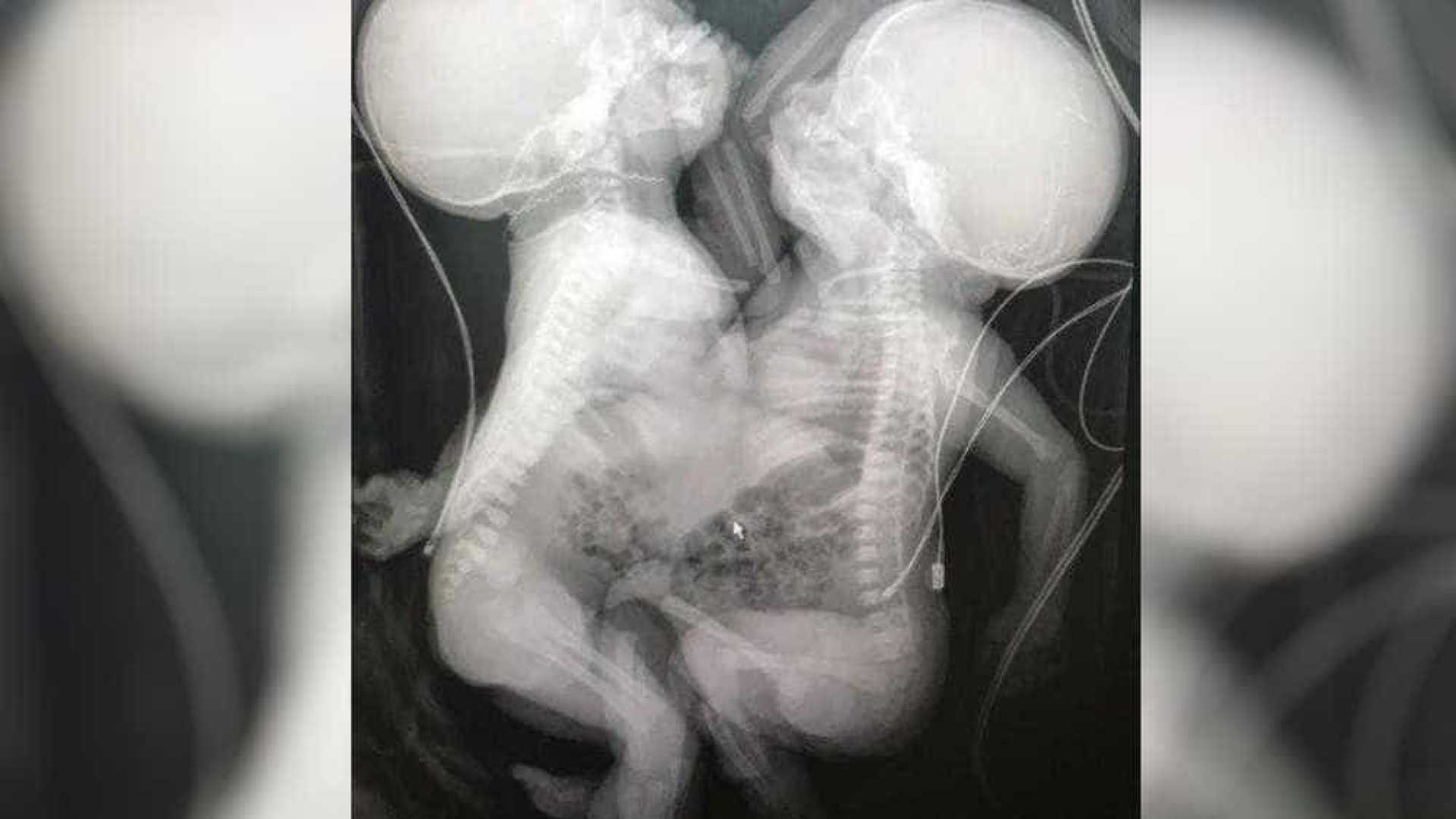 Recém-nascidas, siamesas separadas em Goiânia estão em estado gravíssimo