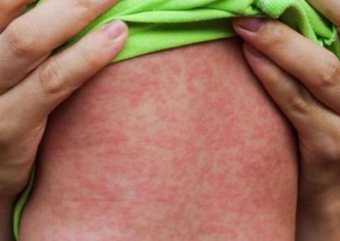 Surto em Manaus: Sobe para 852 o número de casos de sarampo confirmados