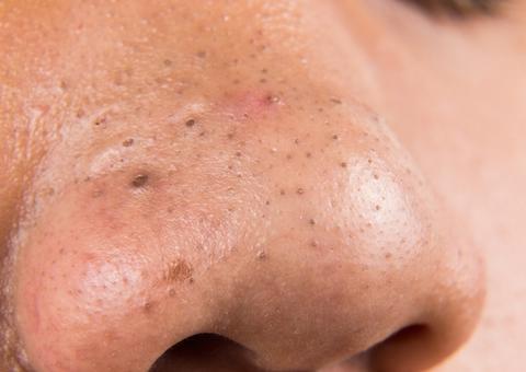 Esse é o motivo pelo qual aparecem tantos cravos no seu nariz