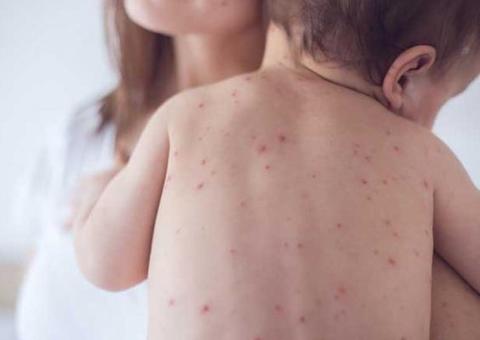 Governo libera R$ 3 milhões para combater surto de sarampo no Amazonas