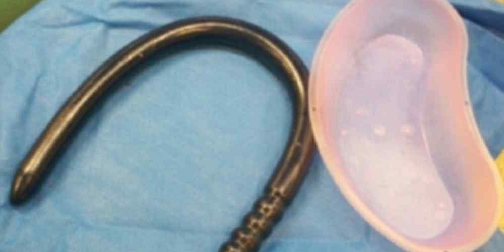 Homem perfura intestino após 'perder controle' com brinquedo sexual