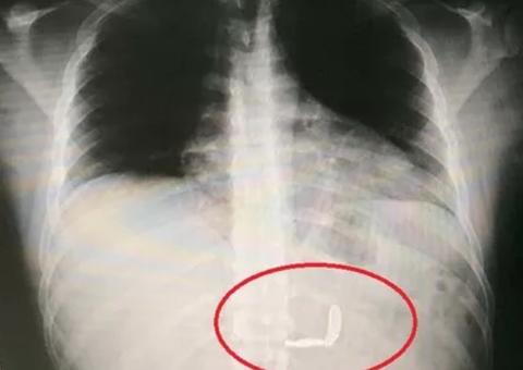 Homem é forçado por amigos a engolir tampinhas de garrafa em bar