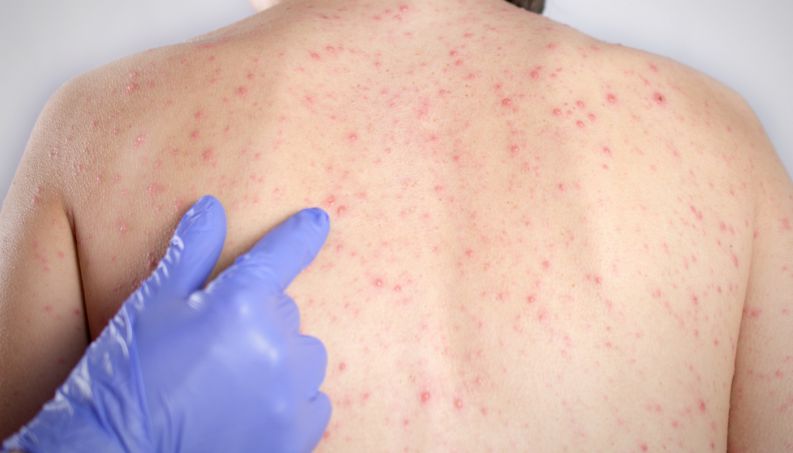 Ministério da Saúde confirma 1,5 mil casos de sarampo no Brasil