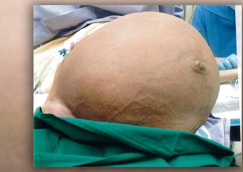 Mulher fica sem respirar por causa de tumor enorme de 27 kg na barriga; Veja