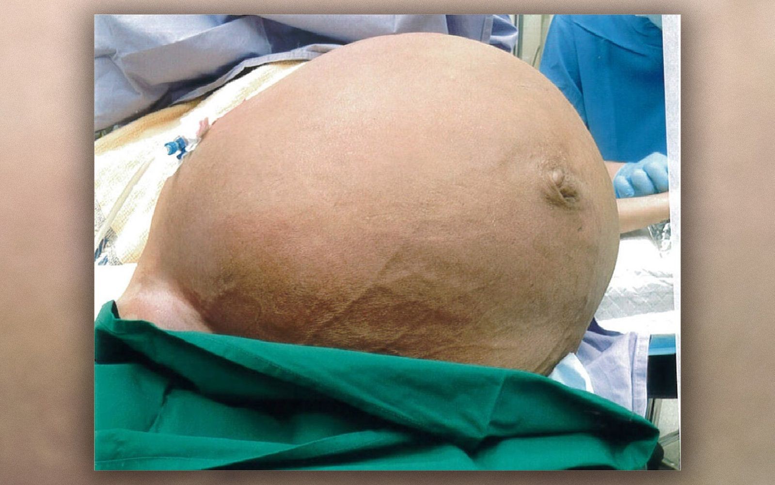 Mulher fica sem respirar por causa de tumor enorme de 27 kg na barriga; Veja