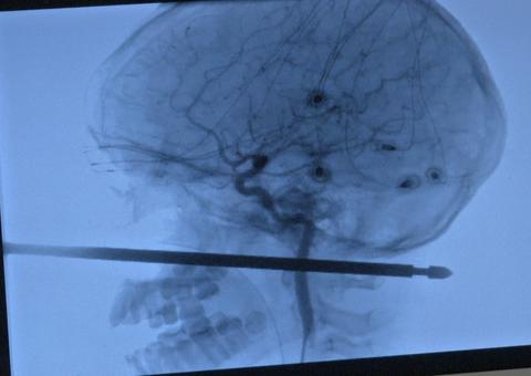 Menino de 10 anos sobrevive após ter cabeça atravessada por espeto de churrasco 