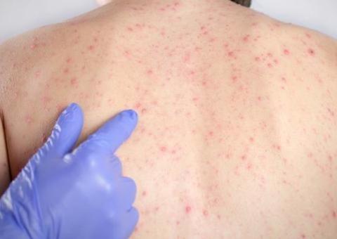 Pela primeira vez, Manaus não tem novos casos de sarampo e número permanece em 906