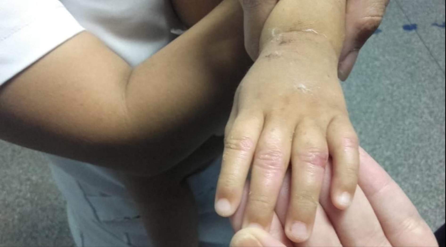 Bebê de um ano é internado com queimaduras pelo corpo em Manaus