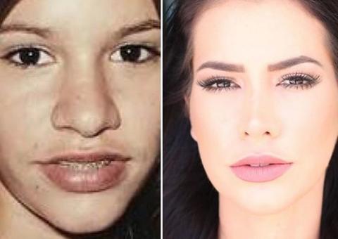  Ex-BBB Adriana aparece irreconhecível em foto antes de 2 cirurgias no nariz