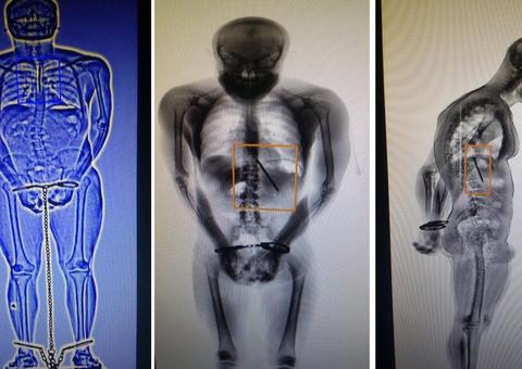 Preso engole faca e finge briga para tentar fugir de presídio 