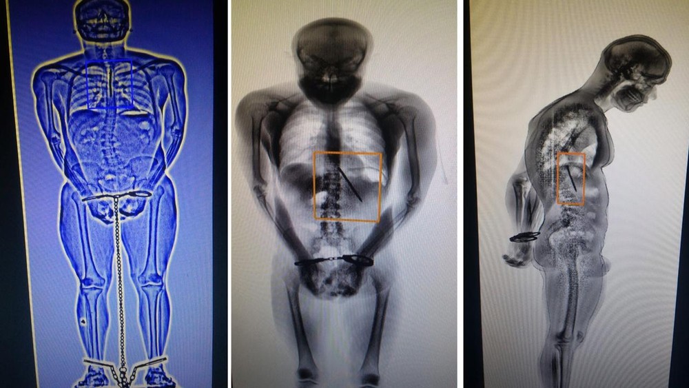 Preso engole faca e finge briga para tentar fugir de presídio 
