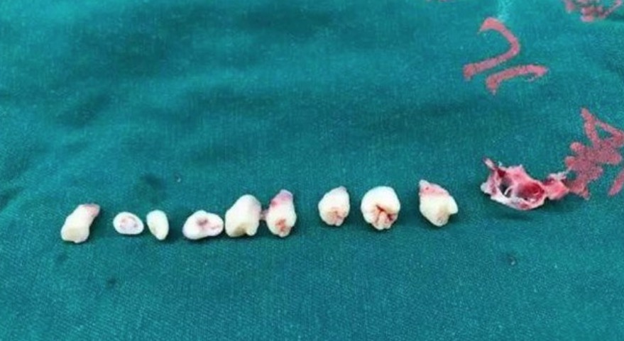 Médicos removem 9 dentes de cérebro de menino de 5 anos