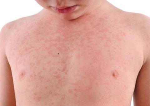 Manaus tem mais de 1,1 mil casos confirmados de sarampo