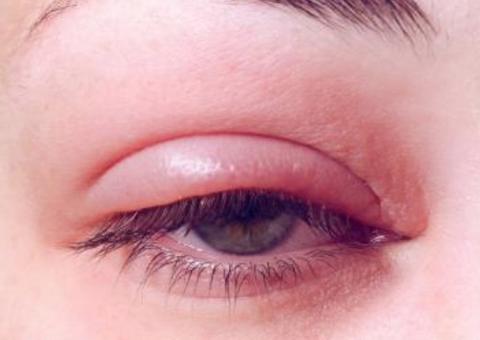 Nem todo terçol é igual: Especialista ensina cuidados e diferenças 