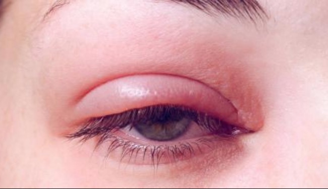 Nem todo terçol é igual: Especialista ensina cuidados e diferenças 