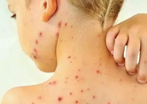 Brasil tem 2.192 casos de sarampo confirmados