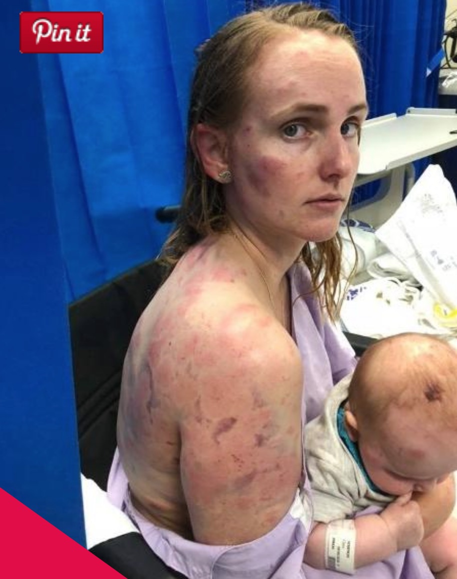 Mãe se fere ao virar escudo para filha durante chuva de granizo