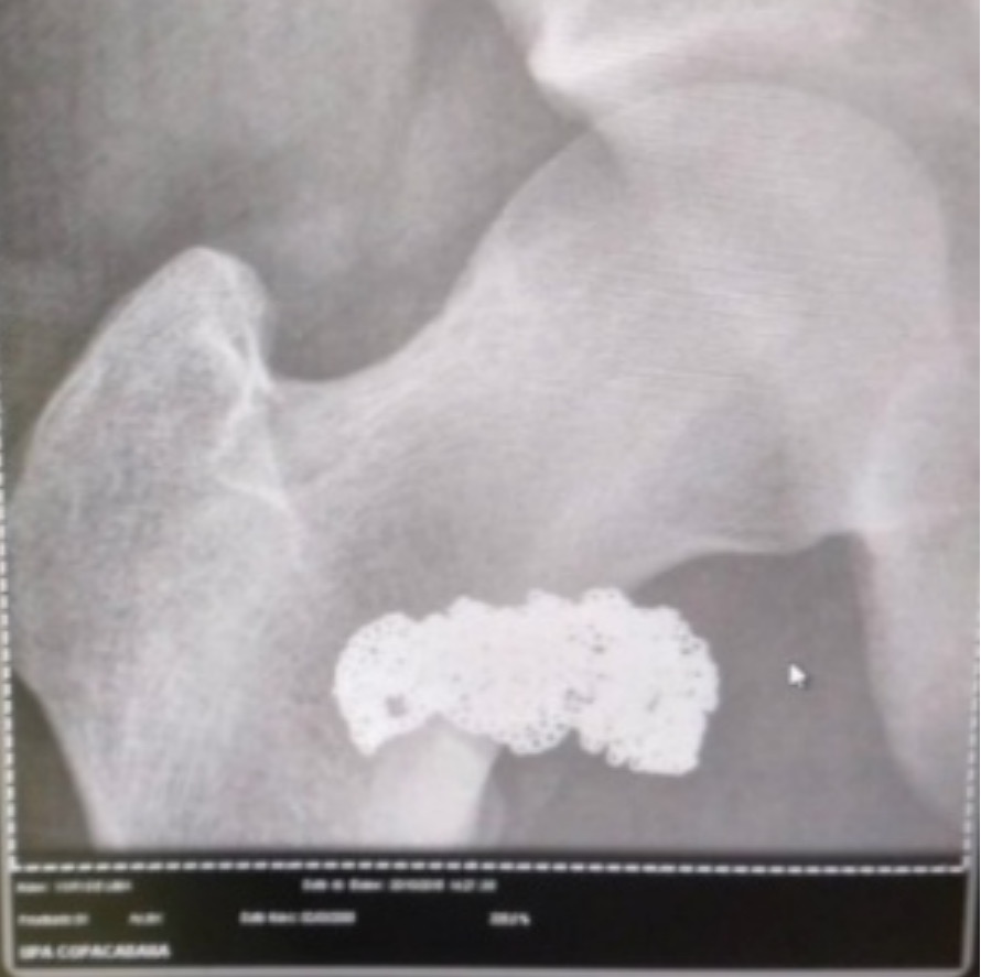 Ladrão engole cordão de ouro e acaba preso após fazer raio-x 