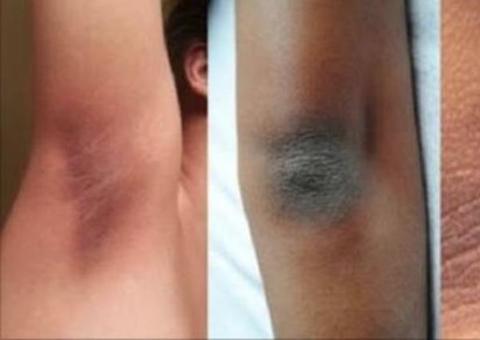 Elimine de vez as manchas escuras na virilha e axilas com receita caseira. Saiba qual