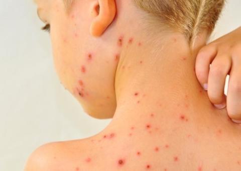 Amazonas tem redução no número de casos notificados de sarampo   