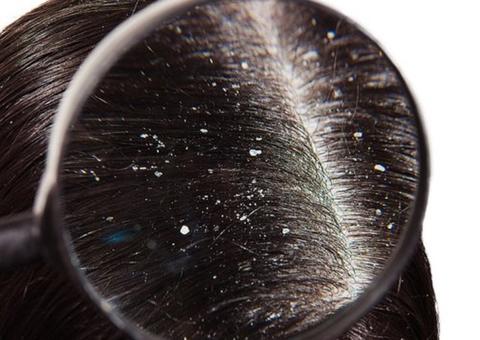 O que você JAMAIS deve fazer quando tem casquinhas no couro cabeludo após progressiva 