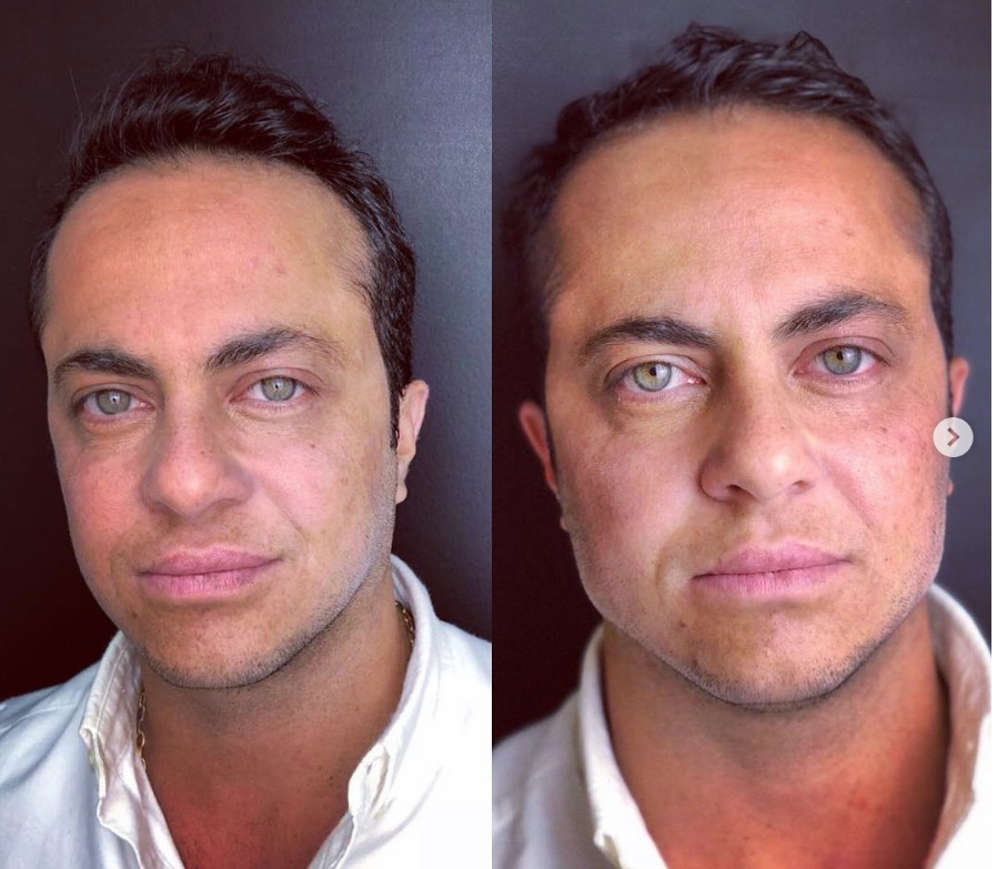 Thammy Miranda faz procedimento para 'aumentar' maxilar