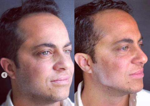 Thammy Miranda faz procedimento para 'aumentar' maxilar