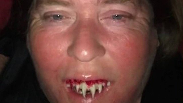 Mulher compra dentes postiços de vampiro para fantasia e pior acontece