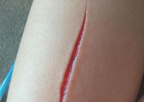 Em Manaus, criança tem braço cortado após suposto desafio