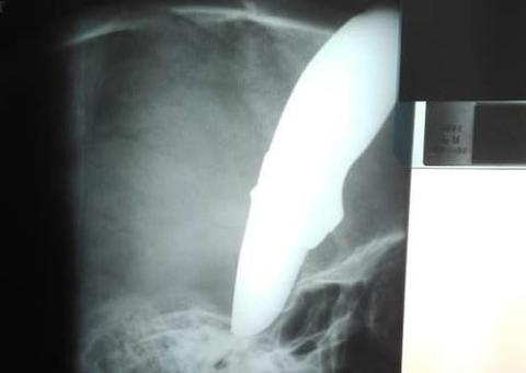 Ciclista tem faca cravada na cabeça e sai pedalando em busca de ajuda