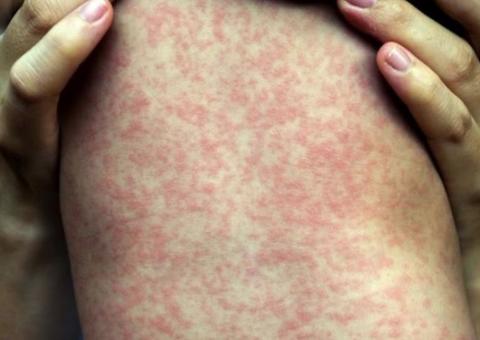 Novo boletim epidemiológico confirma redução de casos suspeitos de sarampo em Manaus