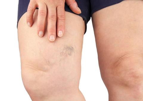 Trombose é mais comum em homens acima dos 40