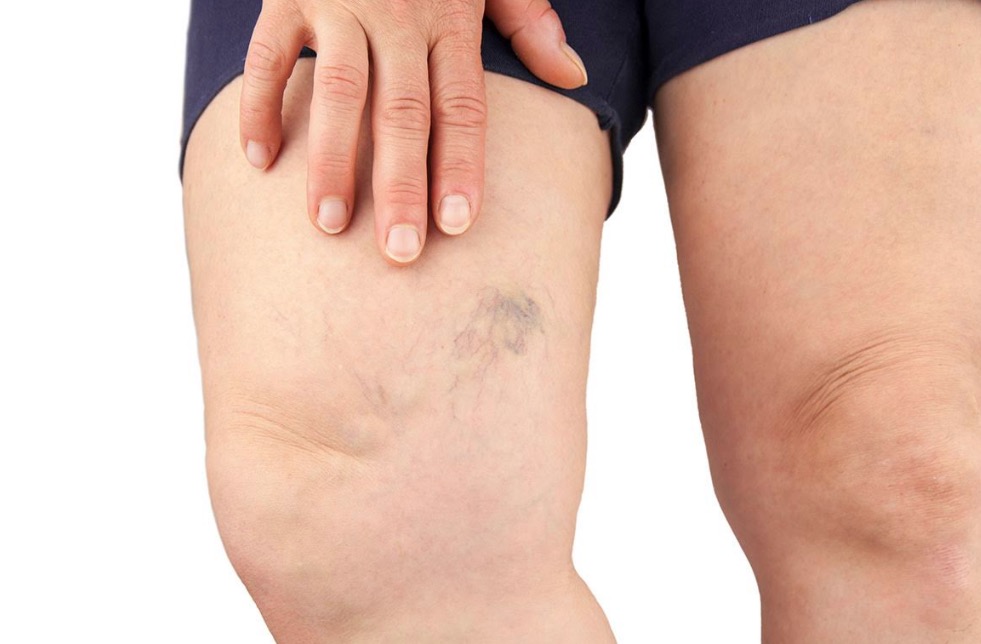 Trombose é mais comum em homens acima dos 40