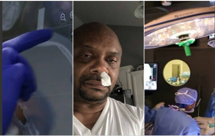 Homem descobre que coriza era vazamento de fluido cerebral