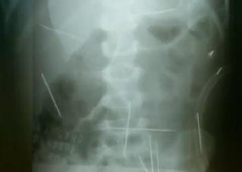 Após 9 anos, menino ainda convive com 4 agulhas dentro do corpo