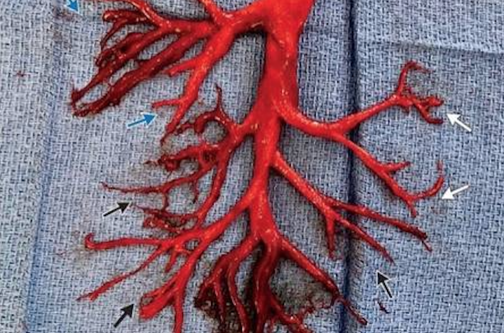 Homem põe parte dos 'brônquios' para fora em crise de tosse e pior acontece