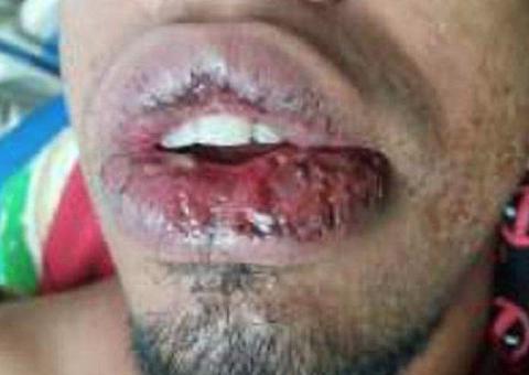 Em Manaus, homem acusa ex-ficante de jogar soda cáustica em seu rosto 