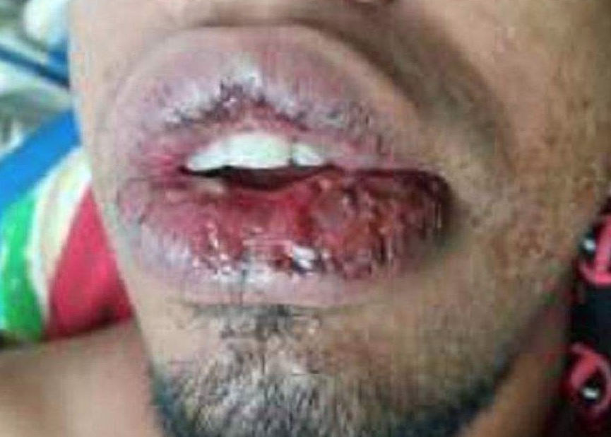 Em Manaus, homem acusa ex-ficante de jogar soda cáustica em seu rosto 