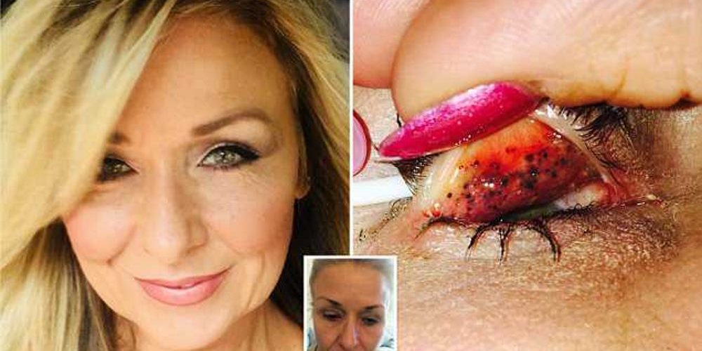 Mulher quase fica cega após passar 25 anos sem retirar rímel dos olhos