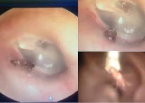 Médico arranca formiga viva de ouvido de paciente 