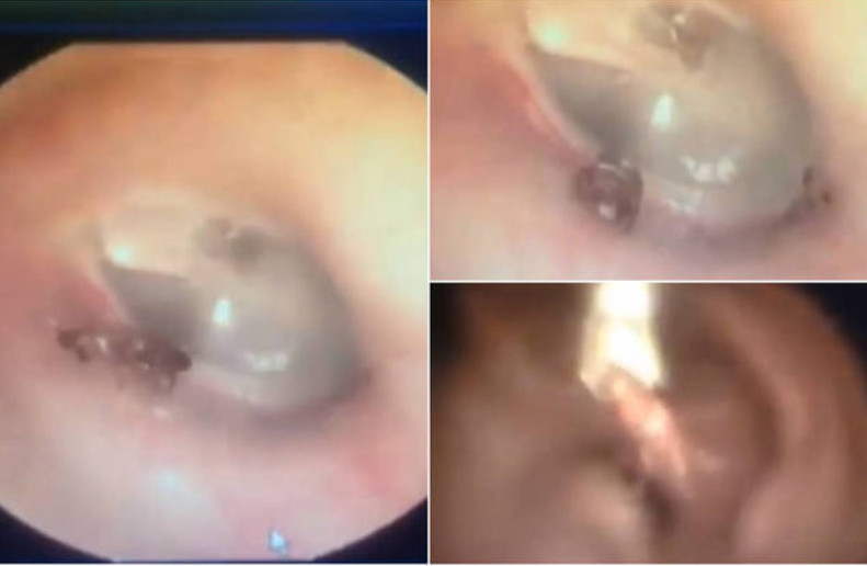 Médico arranca formiga viva de ouvido de paciente 