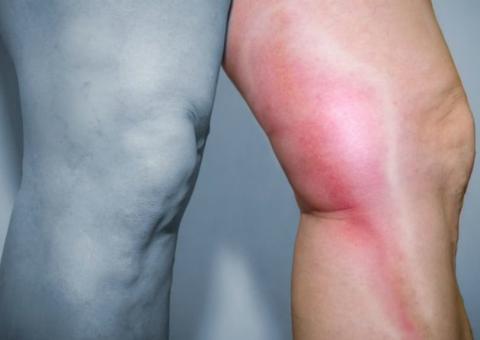 Voos longos podem provocar trombose e até embolia pulmonar