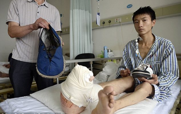 Jovem com pé maior que outro sofre risco de amputação