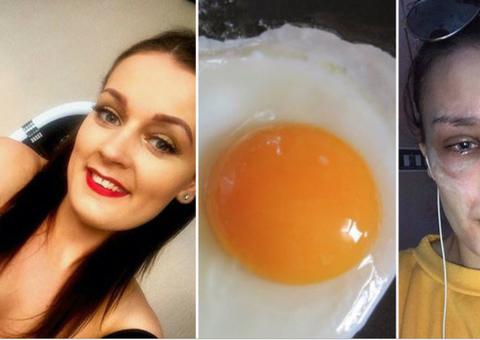 Jovem quase fica cega após ovo explodir no micro-ondas