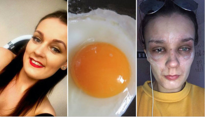 Jovem quase fica cega após ovo explodir no micro-ondas